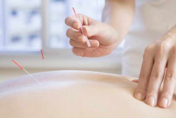 Akupunkturnadeln auf einem Rücken, Hände bei einer Akupunktur Behandlung